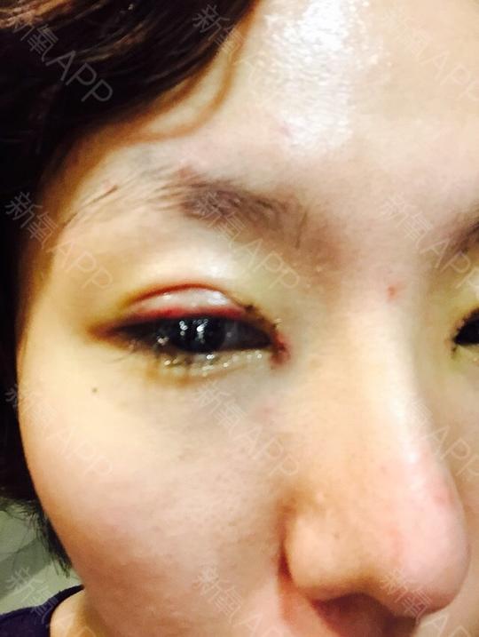 左右眼对比,明显左眼更加不肿,右眼角有点突起的一粒红肿,很怕留疤痕