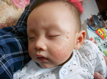 孩子湿疹反复发作为什么
