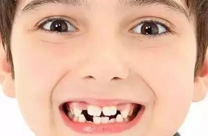孩子牙齿缝隙大是怎么回事