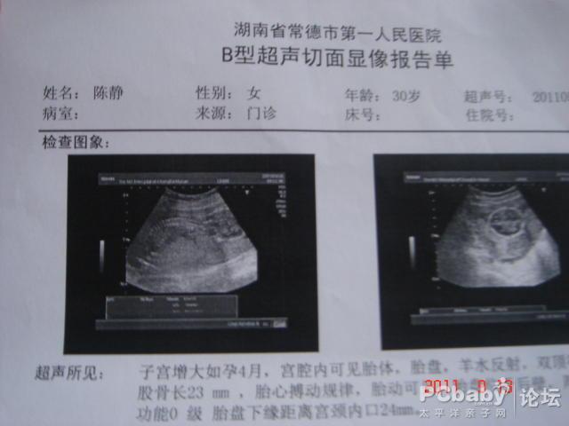 彩超检查出胎儿有唇裂危险吗