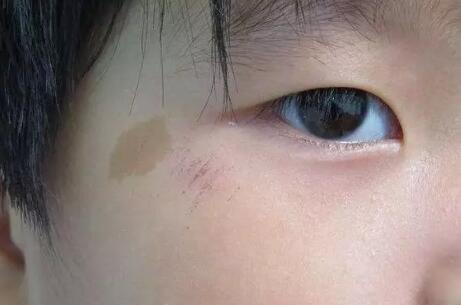 婴儿胎记可以去除掉吗