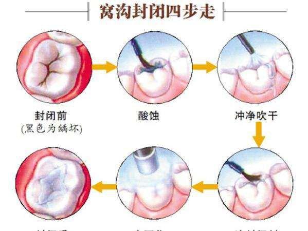 宝宝牙齿有蛀牙怎么保护