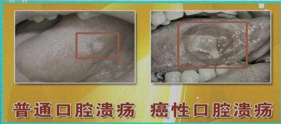口腔溃疡一直不好会得口腔癌吗