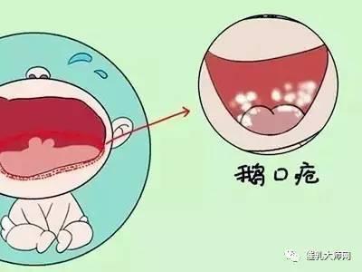 宝宝嘴里有白色的东西是鹅口疮吗