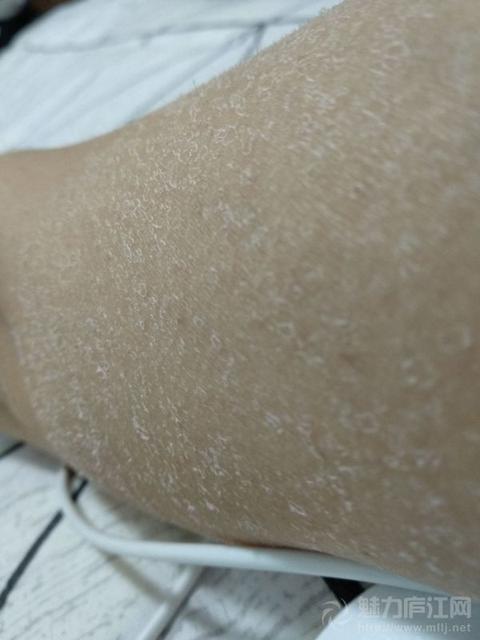 宝宝皮肤干燥瘙痒怎么办