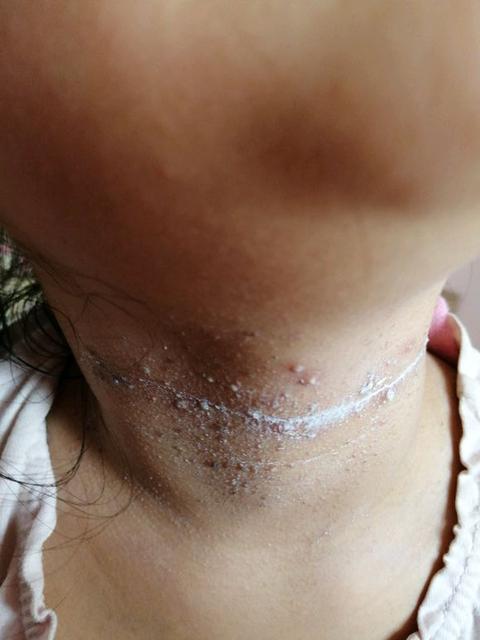 婴儿湿疹可以用好孩子药膏吗