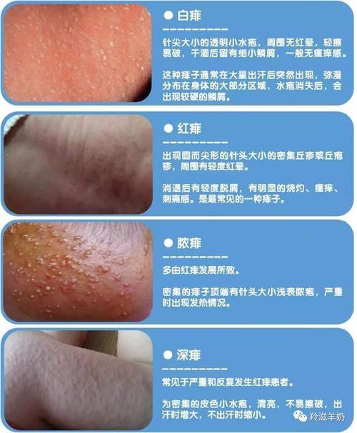 宝宝皮肤干燥瘙痒怎么办
