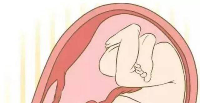导致胎儿脐带绕颈的四个坏习惯