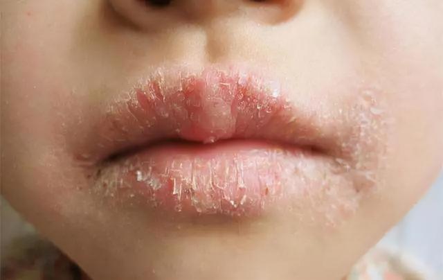 宝宝的皮肤干燥该如何解决