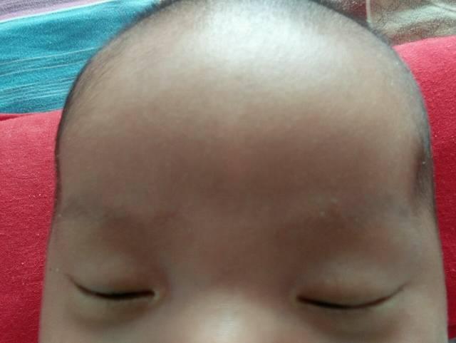 为什么越来越多的孩子有湿疹