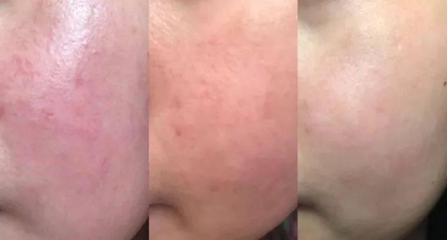 秋季宝宝皮肤过敏怎么办