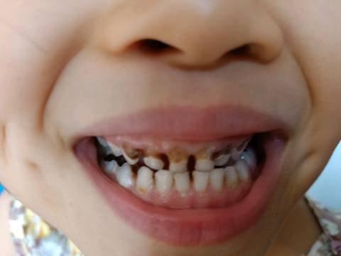 小孩牙齿发黑是缺钙吗图片