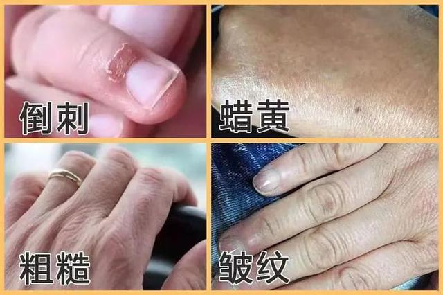 冬天宝宝手指长倒刺怎么办