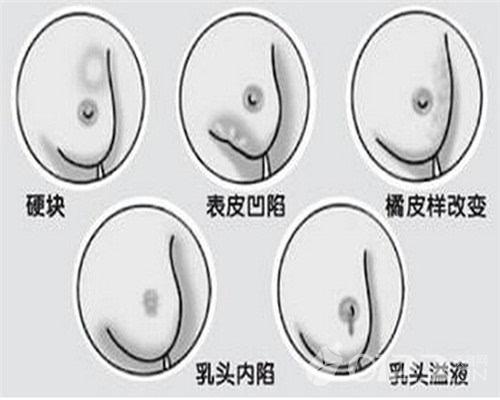 11岁男孩乳房发育直径超4厘米是怎么回事