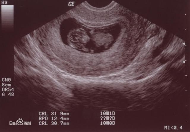 胎心监护怎么看胎儿是缺氧