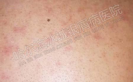 如何防止宝宝食物过敏