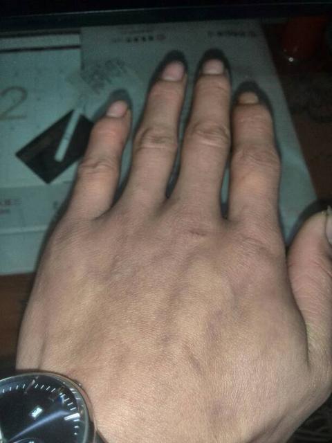 冬季宝宝皮肤问题变多