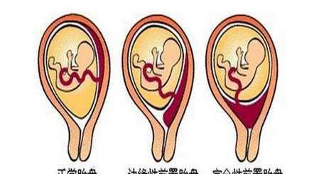 胎盘之前是后壁现在变成前壁怎么回事