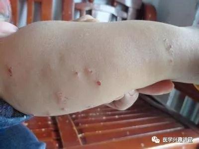 秋天孩子被蚊子咬了怎么办