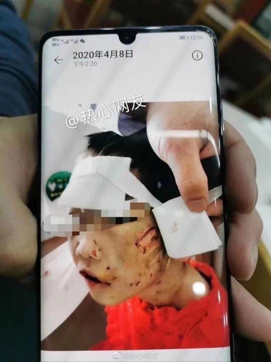 4岁女童被继母殴打进icu:生父也参与殴打，女童现有生命危险