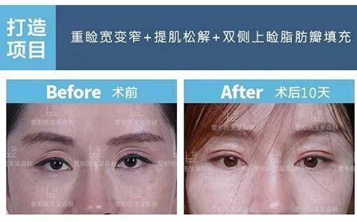 做完双眼皮手术会影响视力吗