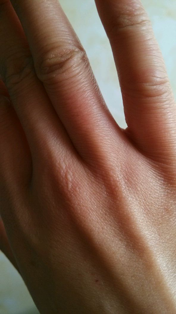 冬季长冻疮怎么办