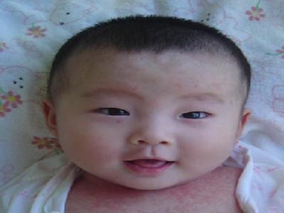 孩子湿疹和痱子有什么区别