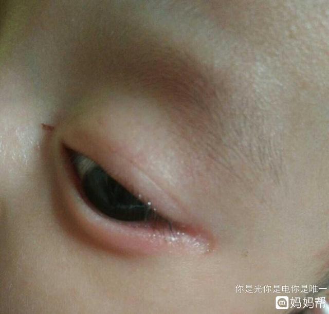 宝宝长湿疹该怎么办呢