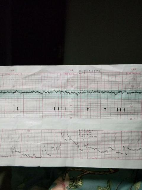 胎心监护是怎么做的图片