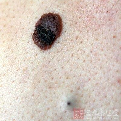 有颗痣长毛怎么办