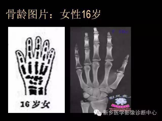 骨龄大长不高的孩子后来长高了吗