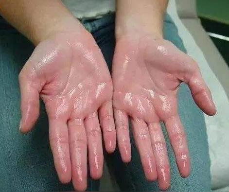 西医治疗手足多汗