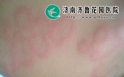 宝宝荨麻疹反复怎么办?