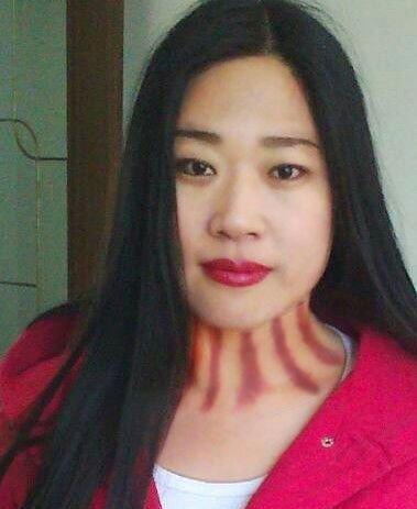 2977882910的揪痧图片_图片搜索