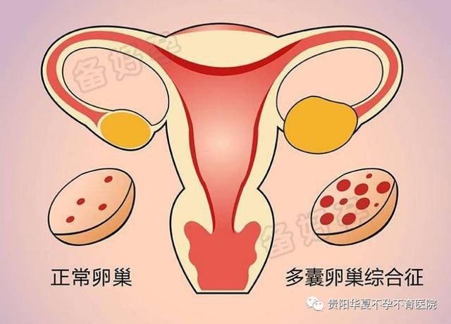 多囊卵巢可以怀孕吗