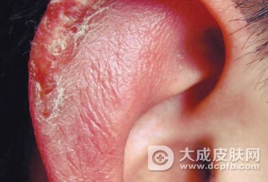 孕期会出现哪些皮肤问题