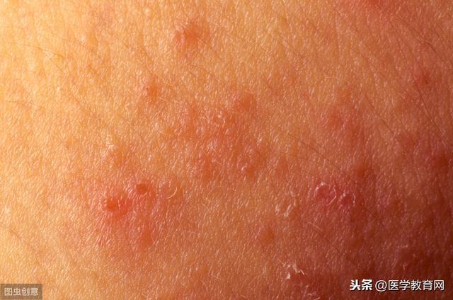 宝宝常见的过敏症状有哪些