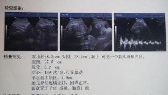 胎儿发育：多大有胎心