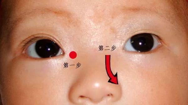 宝宝泪道阻塞了怎么办