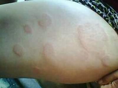 慢性荨麻疹可以根治吗?