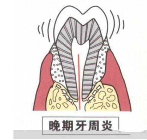 我国九成以上成年人有牙周疾病是真的吗