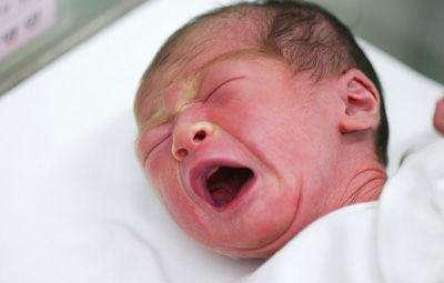 新生儿黄疸的表现和护理如何预防