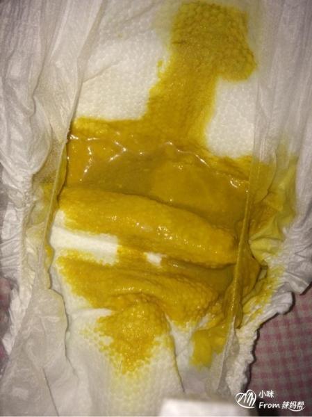 母乳不足会导致宝宝营养不良吗