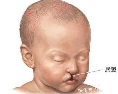 兔唇能治好吗?缺嘴豁嘴修复,唇腭裂患儿慈善援助项目启动
