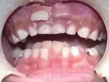 孩子长牙齿的时候不舒服怎么办