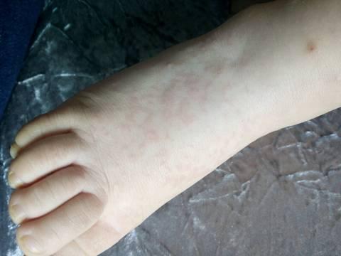 小孩子容易得的荨麻疹