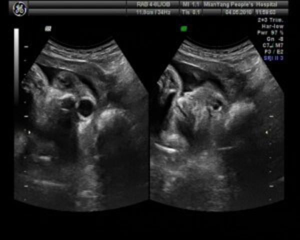 胎儿畸形在孕期可以检查出来吗