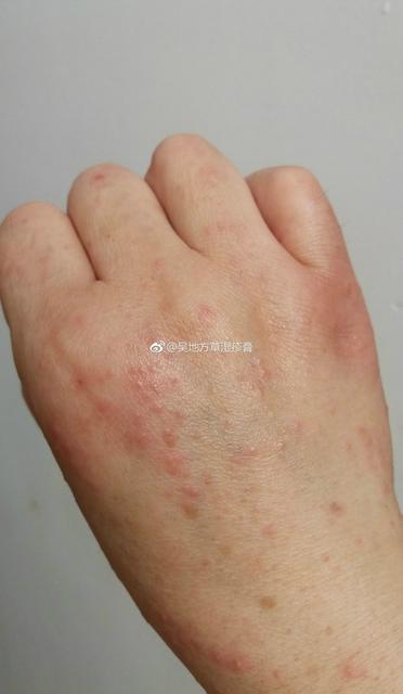 宝宝湿疹表现在哪些部位