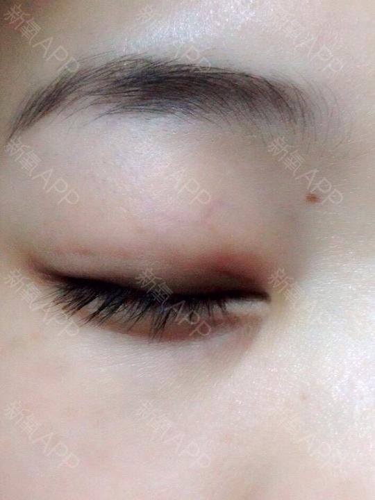 素颜无眼妆的左右眼睁眼and右眼闭眼,给大家参考看看吧,没有疤,不红肿