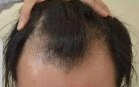 发际线高的人都有什么烦恼